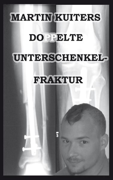 Cover von Doppelte Unterschenkelfraktur